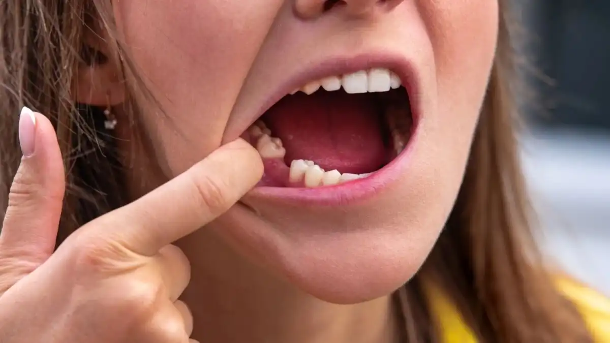 Ansiedade e estresse estão associados a perda dos dentes de pessoas com 30 anos ou mais