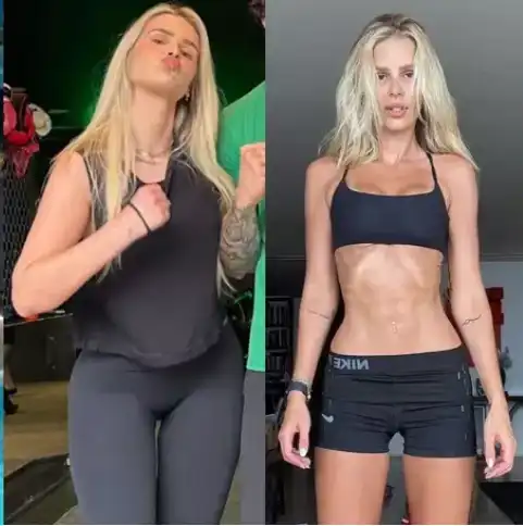 Lipedema – Entenda a doença de Yasmin Brunet