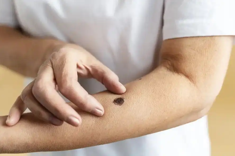 Dezembro Laranja: Câncer de pele e a importância desse mês para a conscientização