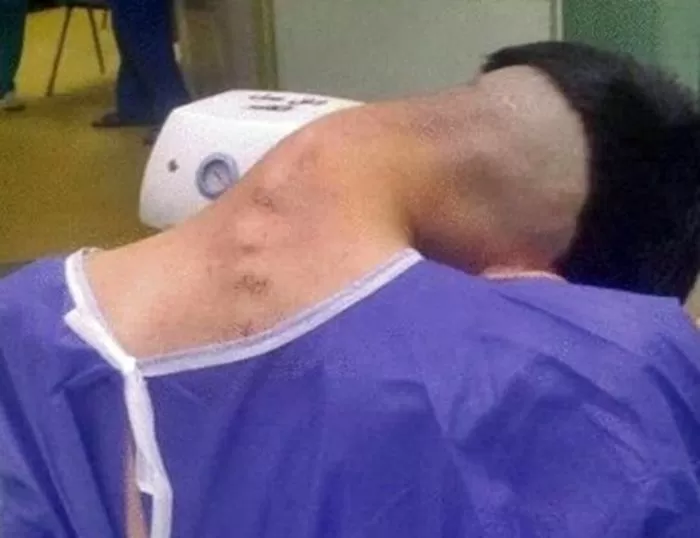Síndrome da Cabeça Caída pelo uso de drogas é registrada por médicos