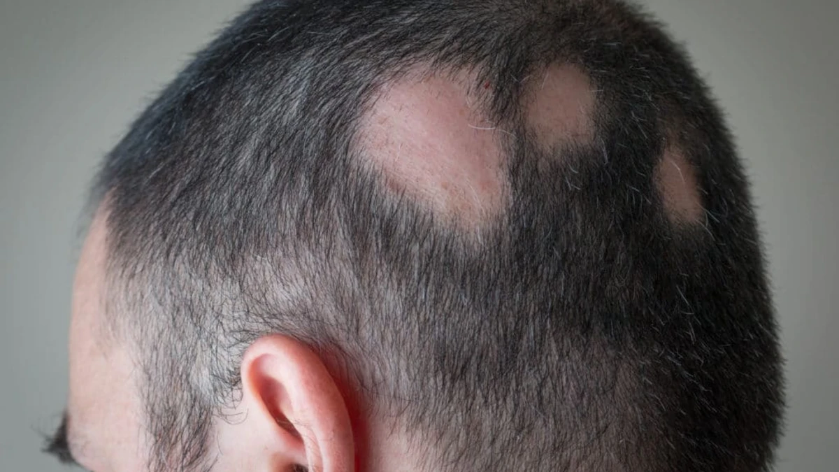 Remédio usado contra artrite ajuda a recuperar cabelo em casos de alopecia grave