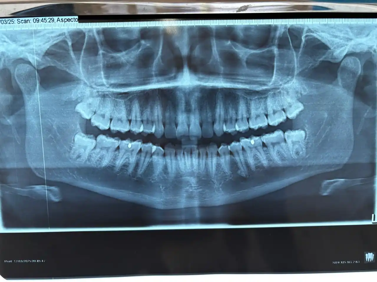 Caraguatatuba realiza 3º mutirão de cirurgia oral para acelerar extrações de sisos