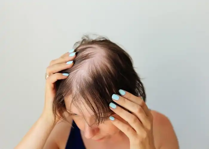 Alopecia e queda de cabelo em mulheres, o que fazer?