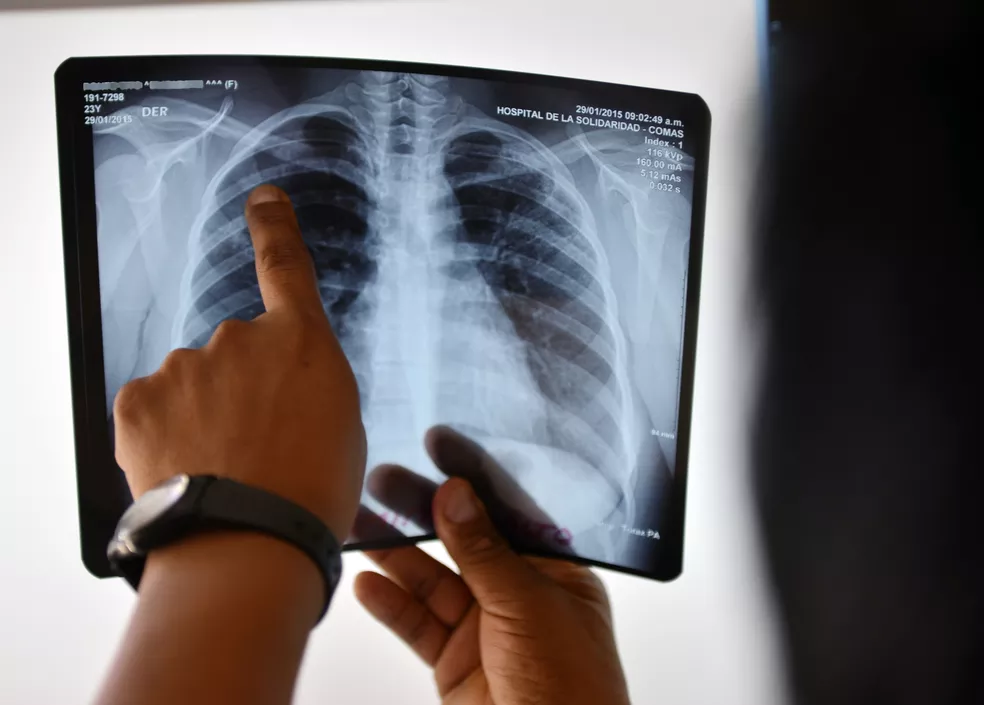 Brasil assina acordo para combate à tuberculose ser prioridade após recorde de mortes em 2021
