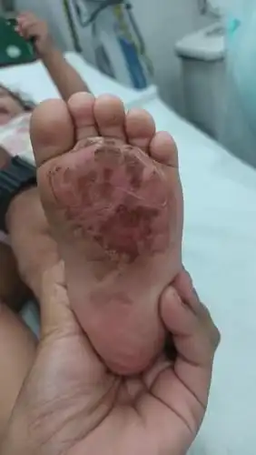 Inquérito policial vai investigar caso de criança com queimaduras em São José
