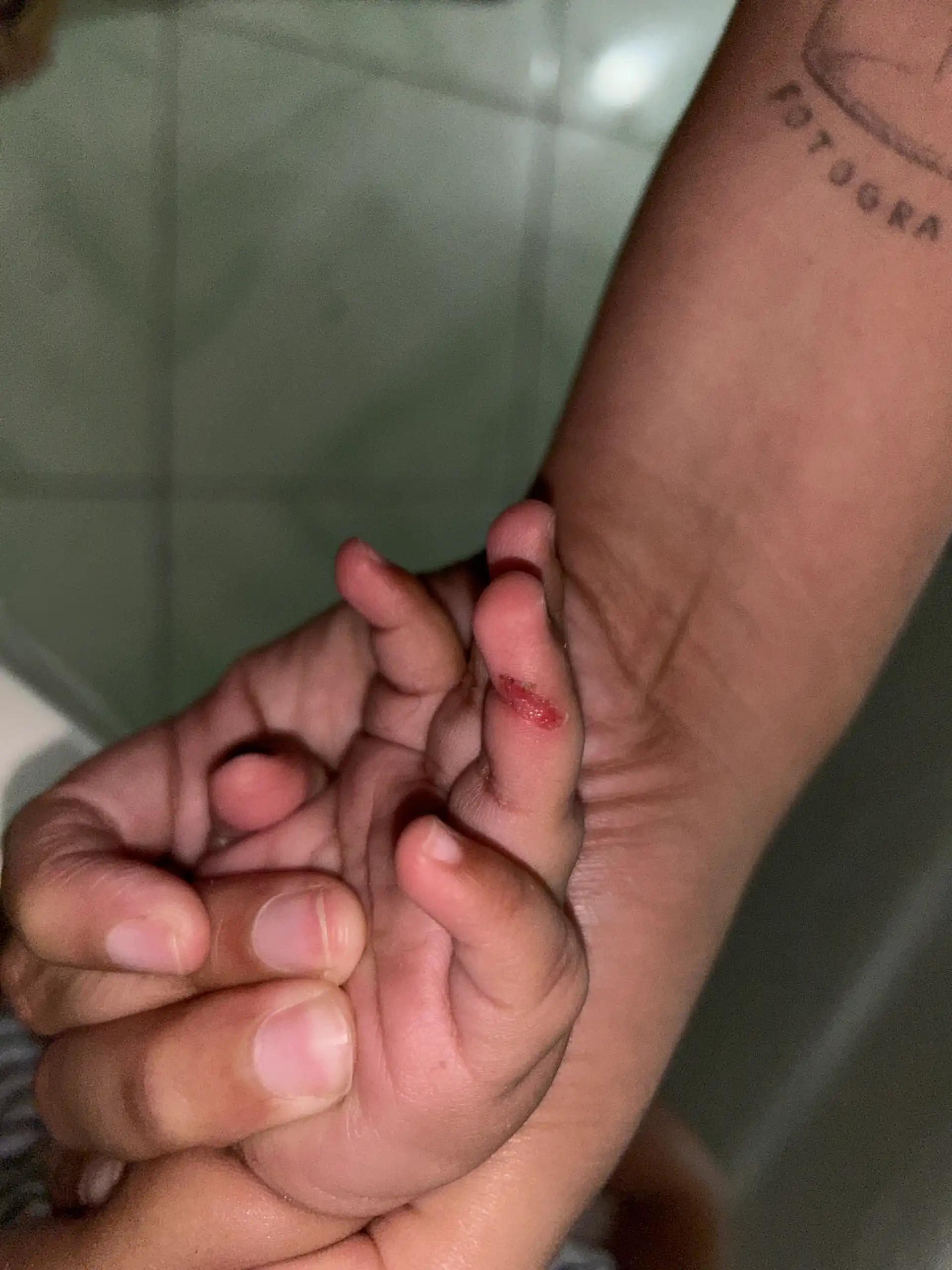 Mãe denuncia machucado em bebê após saída de berçário e cobra explicações em São José dos Campos