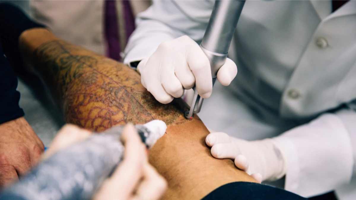 Para onde vai a tinta da tatuagem removida a laser? Entenda o processo