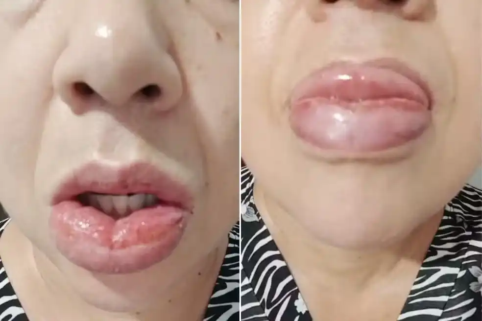 Após 1,2 mil relatos de reações, pasta da Colgate com fórmula alterada segue com venda proibida