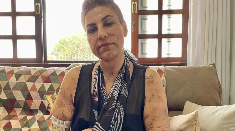 Após mulher sobreviver a ataque de cachorro, veterinário alerta sobre comportamento de cães