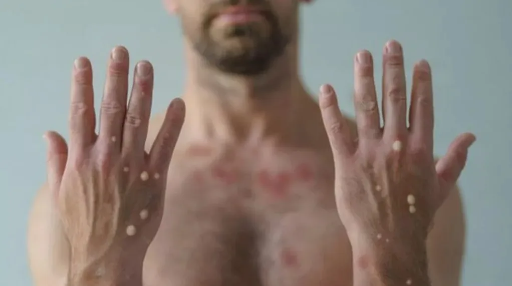 Mpox pode ser sexualmente trasmissível? Especialista explica como doença funciona e importância de cuidados