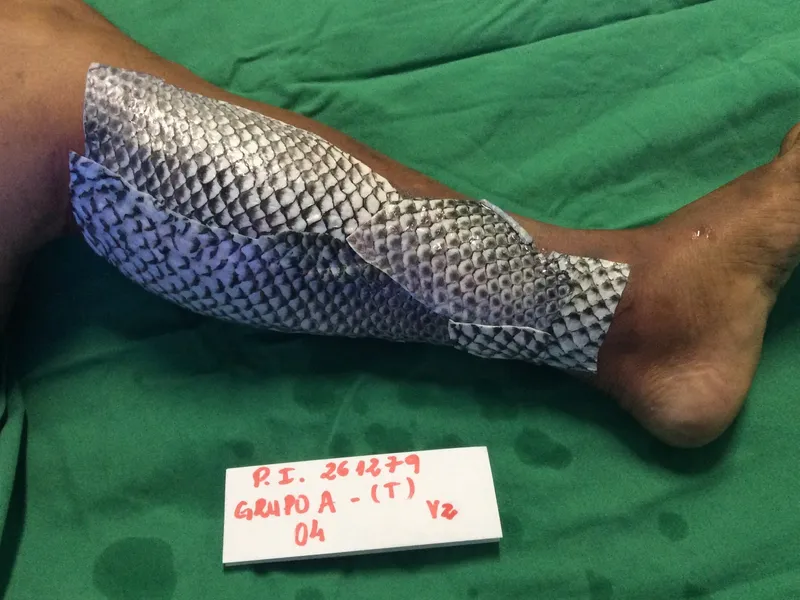 pele-de-tilapia-aplicada-sobre-queimadura-para-diminuir-dor-e-acelerar-cicatrizacao-1596762345388_v2_4x3.jpg