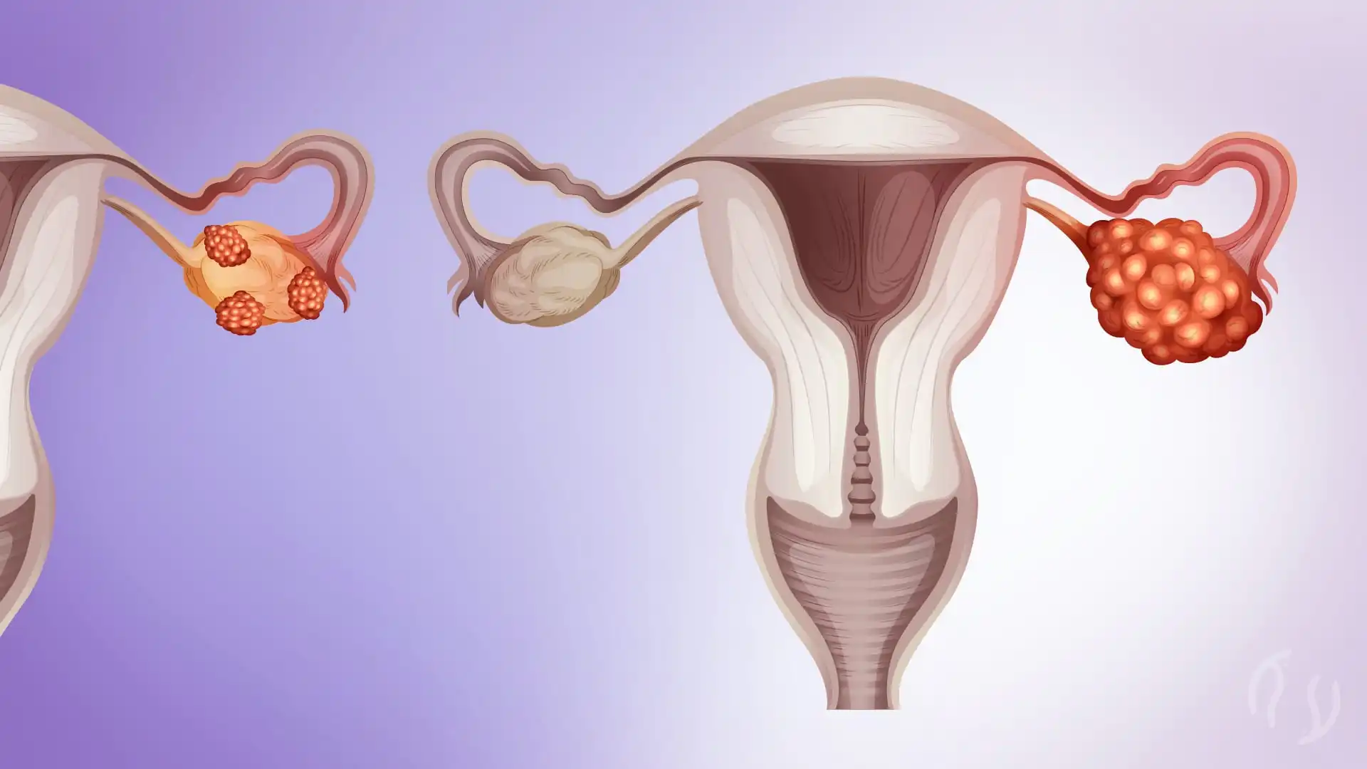 Endometriose