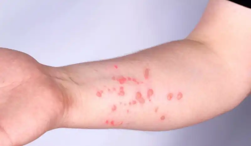 Mpox pode virar uma epidemia? Infectologia explica