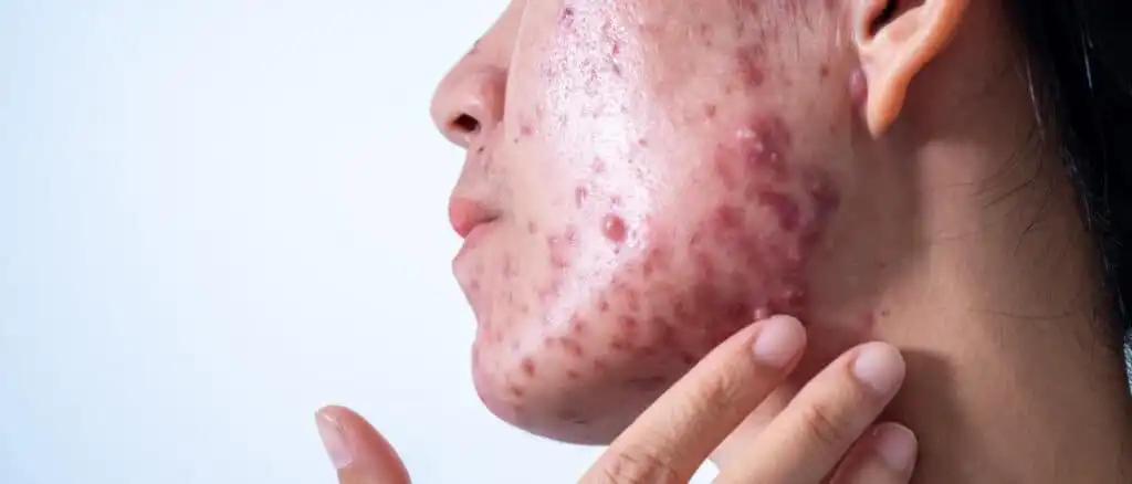 Produtos para acne com peróxido de benzoíla: quais os riscos para a pele?