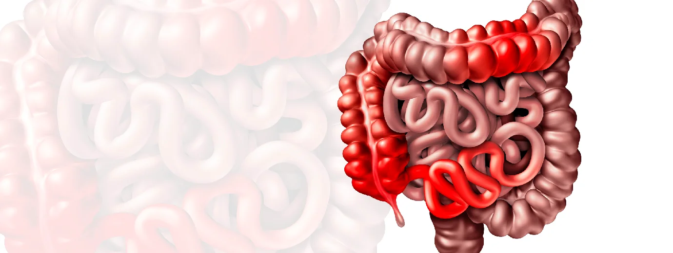 Ação “Maio Roxo” alerta para doenças inflamatórias intestinais