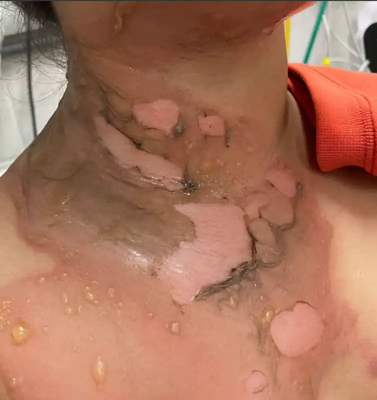 Menina de 07 anos sofre queimaduras com água quente em escola de São José 