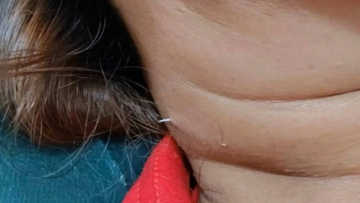 Mulher engole espinha de peixe e objeto perfura seu pescoço duas semanas depois