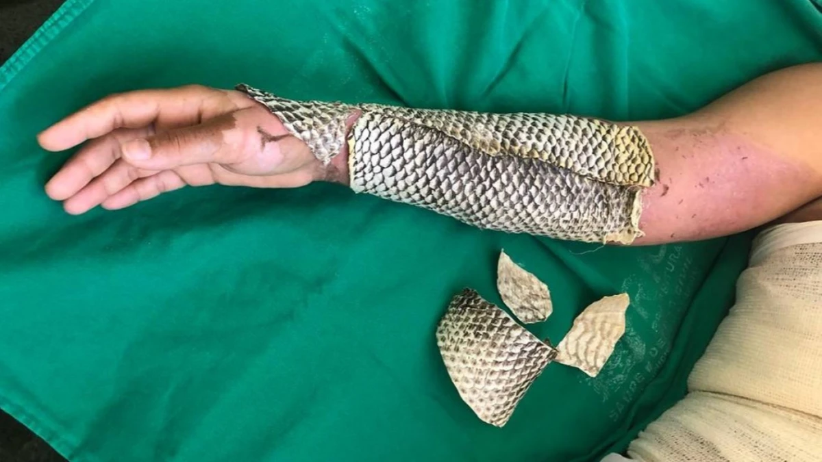 Brasil terá primeira fábrica do mundo de pele de tilápia para tratar queimaduras