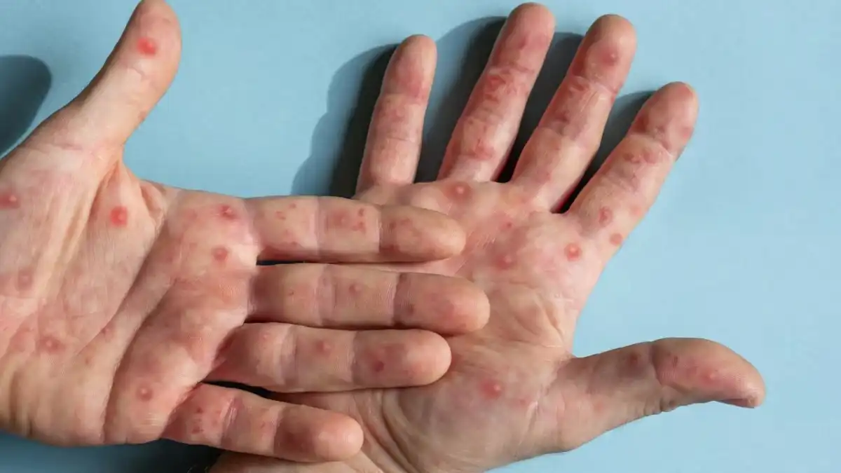 Lorena confirma primeiro caso de Mpox em um homem de 25 anos