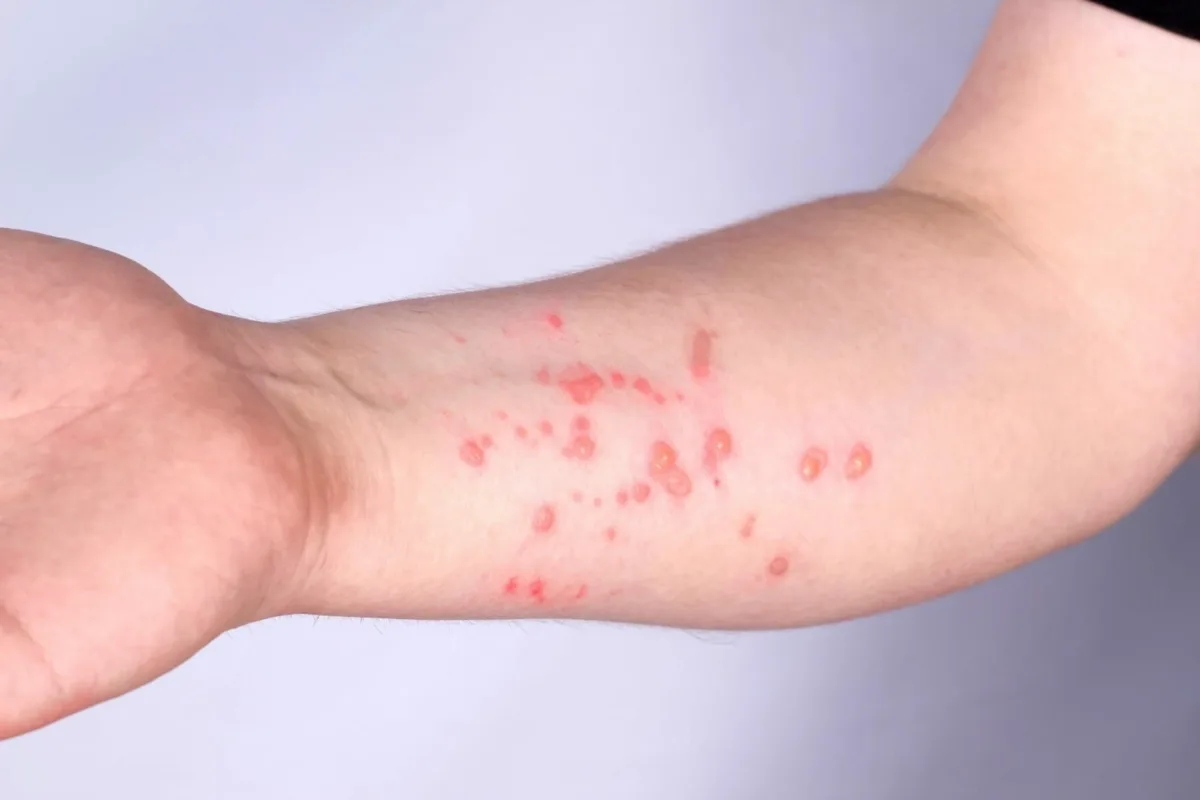 Casos de Mpox ultrapassam o total de 2023 e chamam atenção de especialistas