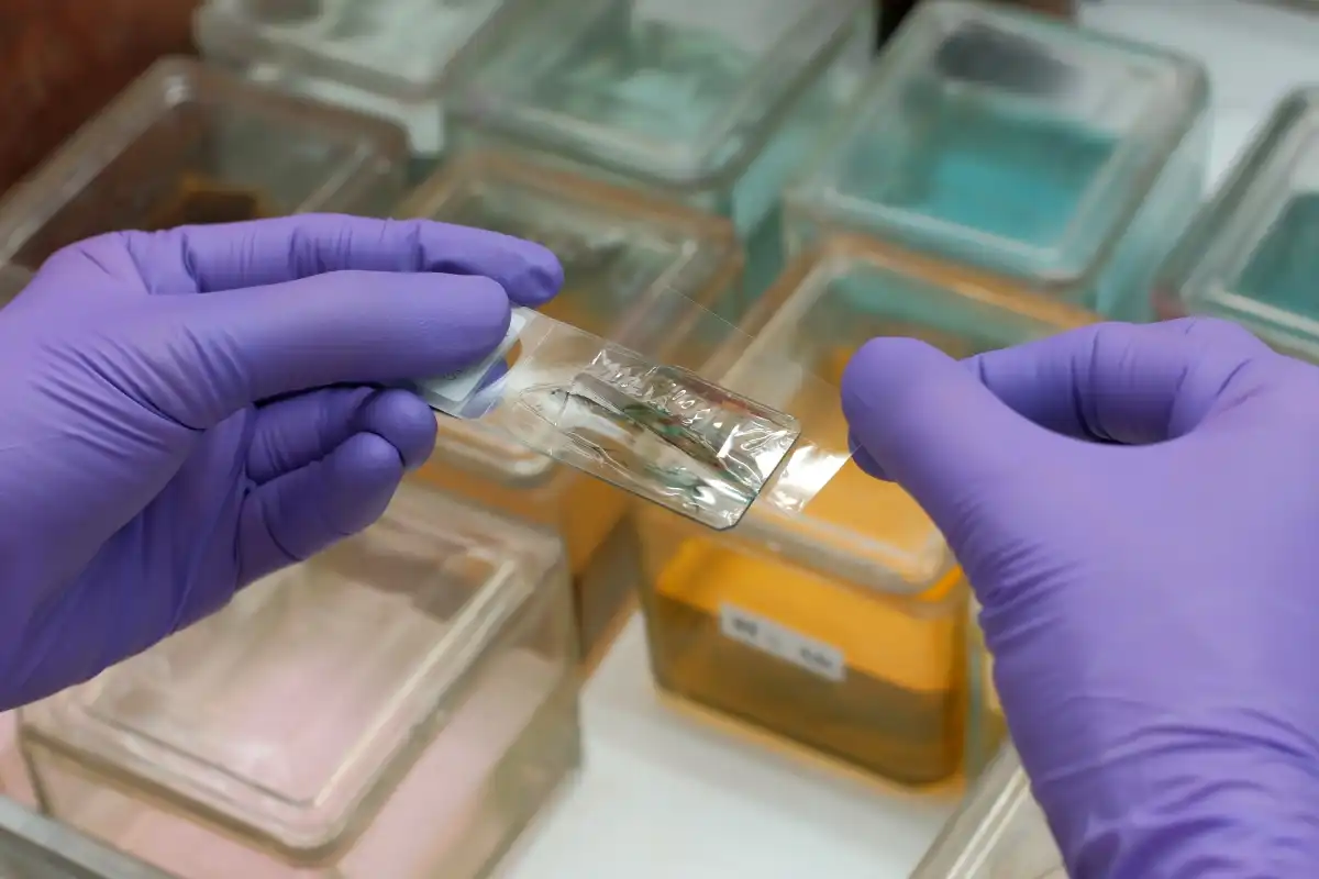 SUS Substitui Papanicolau por exame molecular