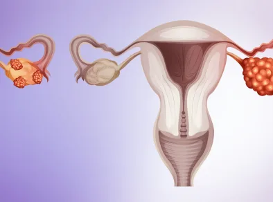 Endometriose