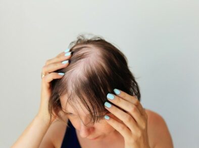 Alopecia e queda de cabelo em mulheres, o que fazer?