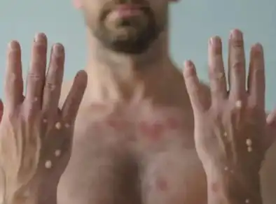 Mpox pode ser sexualmente trasmissível? Especialista explica como doença funciona e importância de cuidados