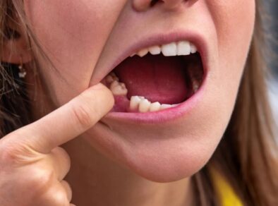 Ansiedade e estresse estão associados a perda dos dentes de pessoas com 30 anos ou mais