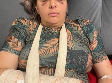 Mulher é agredida e tem o pulso quebrado pelo ex-companheiro em São José