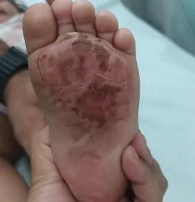 Inquérito policial vai investigar caso de criança com queimaduras em São José