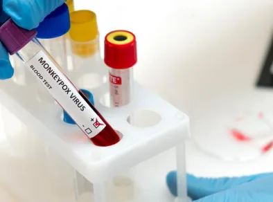 Alerta! Brasil registra primeiro caso de contaminação por nova variante do vírus mpox