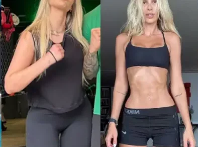 Lipedema – Entenda a doença de Yasmin Brunet
