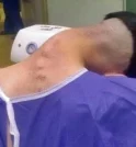 Síndrome da Cabeça Caída pelo uso de drogas é registrada por…