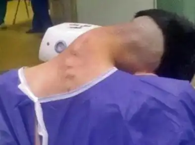 Síndrome da Cabeça Caída pelo uso de drogas é registrada por médicos