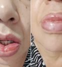 Após 1,2 mil relatos de reações, pasta da Colgate com fórmula alterada…