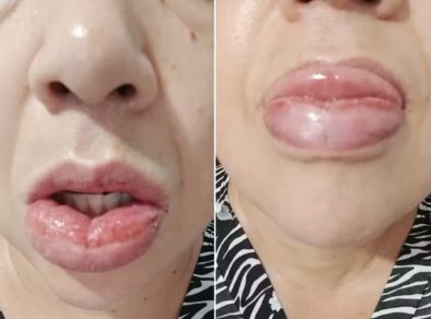 Após 1,2 mil relatos de reações, pasta da Colgate com fórmula alterada segue com venda proibida