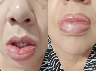 Após 1,2 mil relatos de reações, pasta da Colgate com fórmula alterada segue com venda proibida