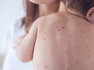 Queda da vacinação contra o Sarampo alerta Organização Mundial de Saúde