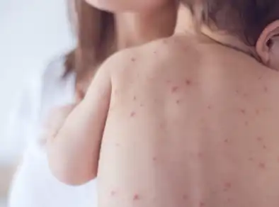 Queda da vacinação contra o Sarampo alerta Organização Mundial de Saúde