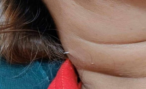 Mulher engole espinha de peixe e objeto perfura seu pescoço duas semanas depois
