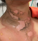Menina de 07 anos sofre queimaduras com água quente em escola…