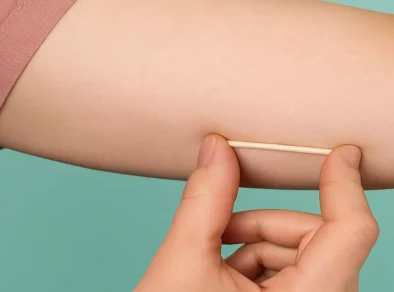 Implanon para todos: Implante contraceptivo passa a ter cobertura obrigatória nos planos de saúde