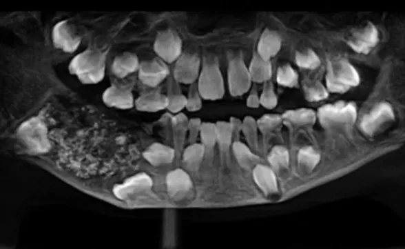 Menino de 7 anos tem 526 dentes retirados em cirurgia rara na Índia