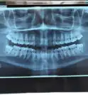Caraguatatuba realiza 3º mutirão de cirurgia oral para acelerar extrações de…